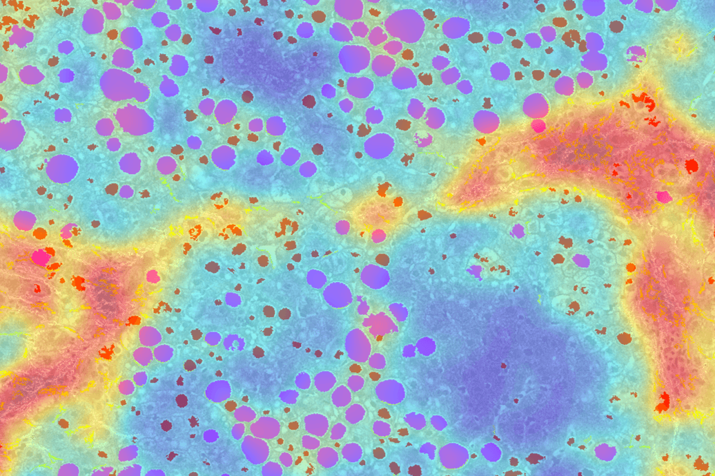 PharmaNest, NIH and VCU Launch Confirmatory Retrospective Outcome Study With 1,765 Patients to Advance AI-Driven Digital Pathology in MASLD